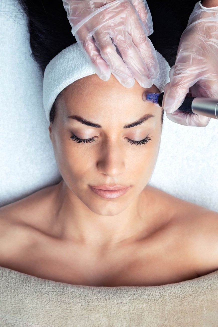 Le microneedling est une technique non invasive et totalement indolore.