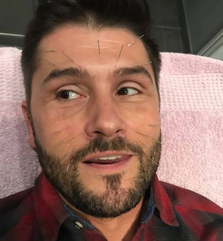 Christophe Beaugrand en pleine séance d'acupuncture chez Céline Claret-Coquet
