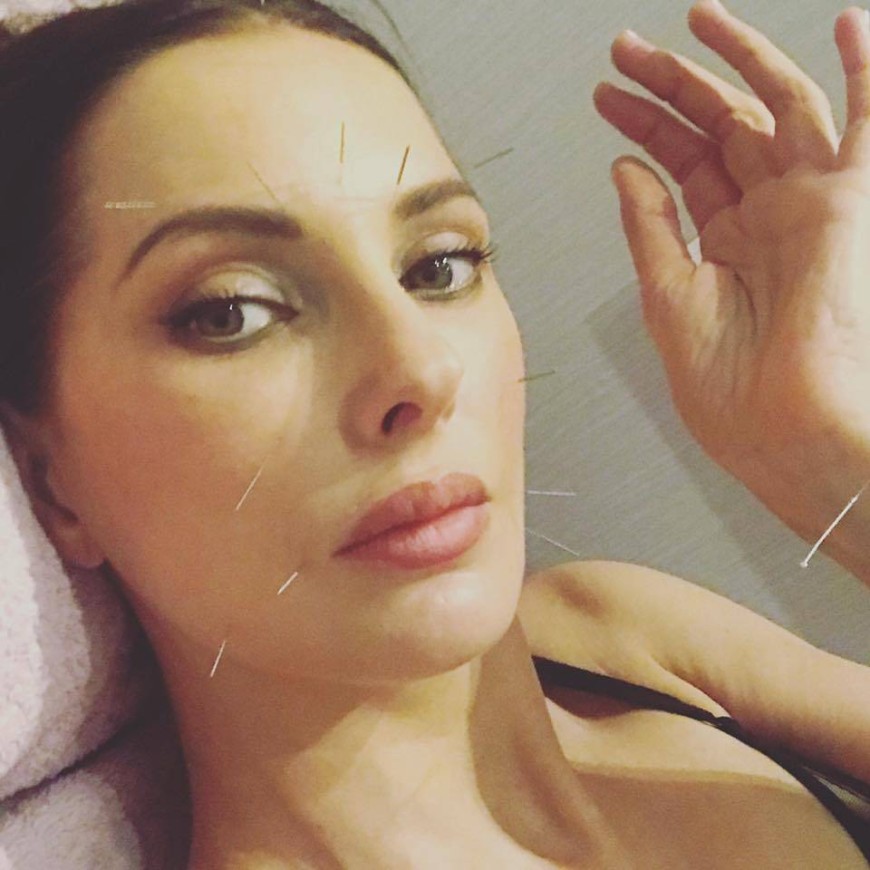 La superbe actrice Frédérique Bel en pleine séance d'acupuncture avec Céline Claret-Coquet