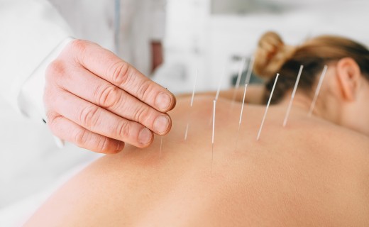 L'Acupuncture à Lyon