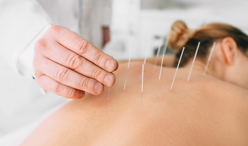 L'acupuncture diminue le stress et les pensées négatives