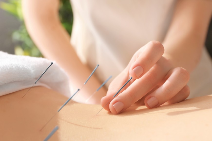 Les aiguilles d’acupuncture sont fines comme un cheveu