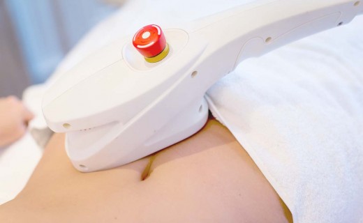 La Cryolipolyse avec le Cryoslim®