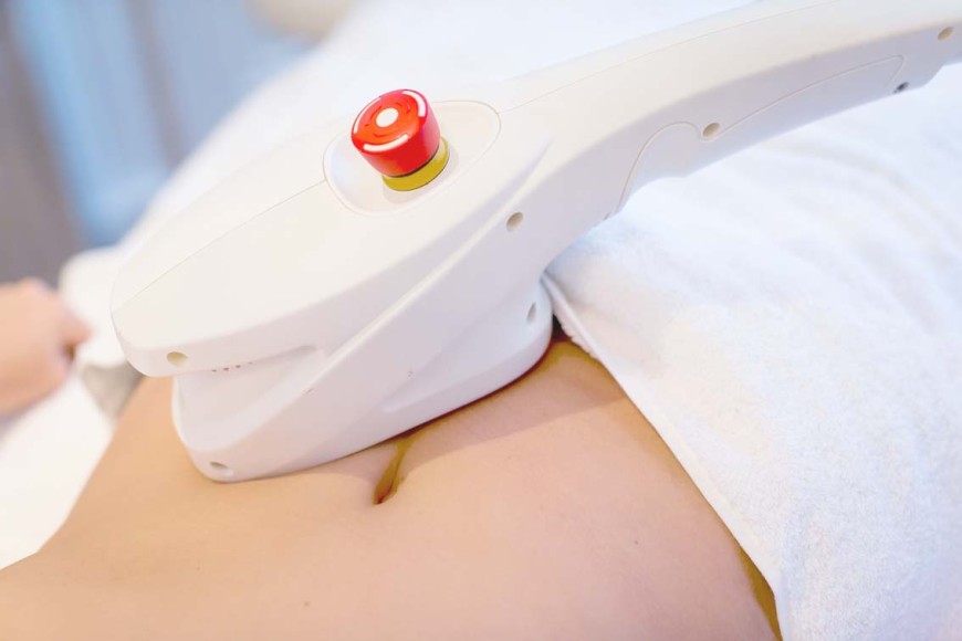 La Cryolipolyse traite les bourrelets localisés pour une peau plus lisse