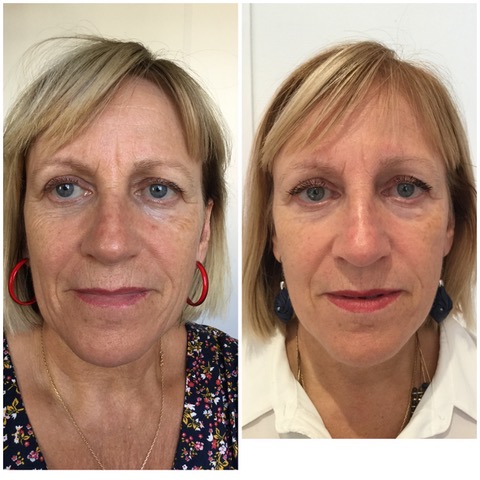 Résultat du soin Hifu sur une patiente après 2 mois de la première séance le résultat finale est optimal à 6 mois.